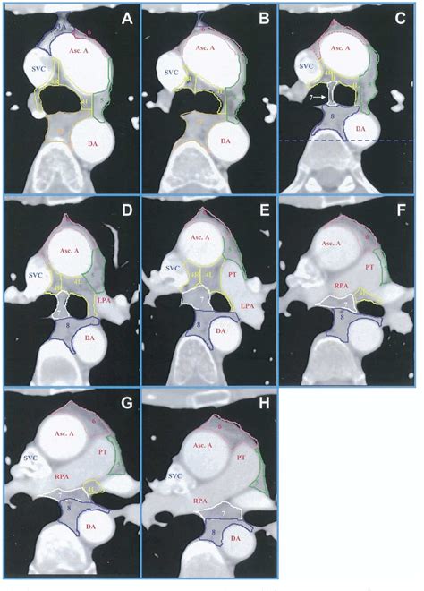 Figure 2 From CT Based Definition Of Thoracic Lymph Node Stations An