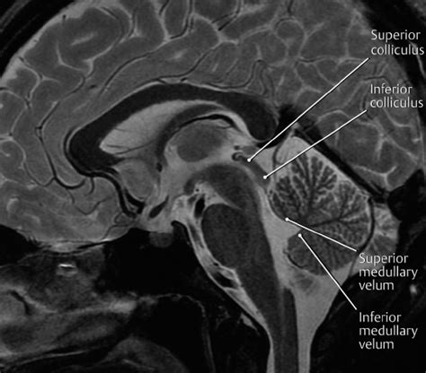 Inferior Colliculus Mri