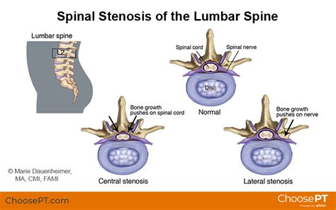 Guide | Physical Therapy Guide to Spinal Stenosis | Choose PT