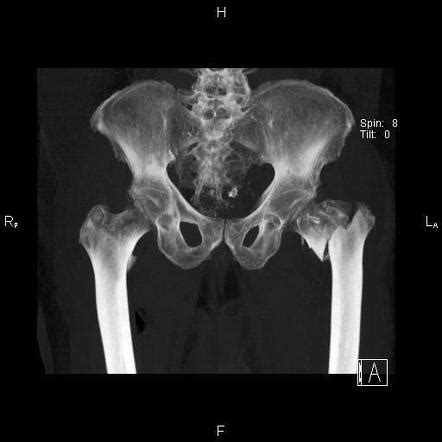 Femoral Inter Trochanteric Fracture Displaced Radiology Case