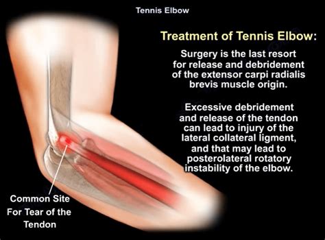 Tennis Elbow Tennis Elbow Ebraheim Devon Patel Elbow