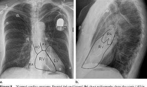 Figure 5 From Radiography Of Cardiac Conduction Devices A