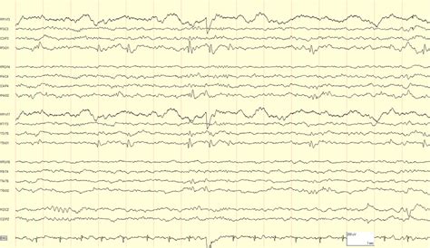 PANAYIOTOPOULOS SYNDROME