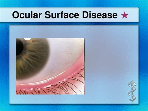 Ppt Ocular Surface Diseases Powerpoint Presentation Free Download