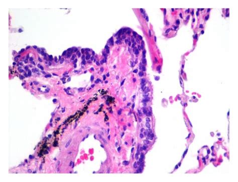 Case 2 A Carcinoid Tumor B Carcinoid With Strong And Diffuse