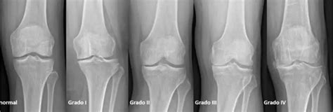 Artrosis De Rodilla O Gonartrosis Dr Juan Mendoza