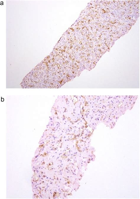 Malignant Hepatic Epithelioid Hemangioendothelioma With Villaret