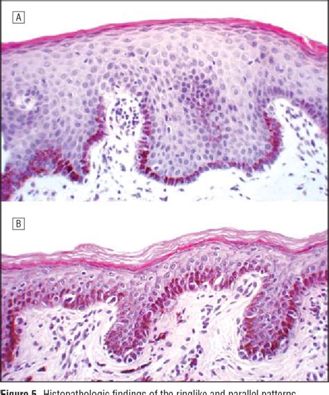 Figure 2 From The Ringlike Pattern In Vulvar Melanosis A New