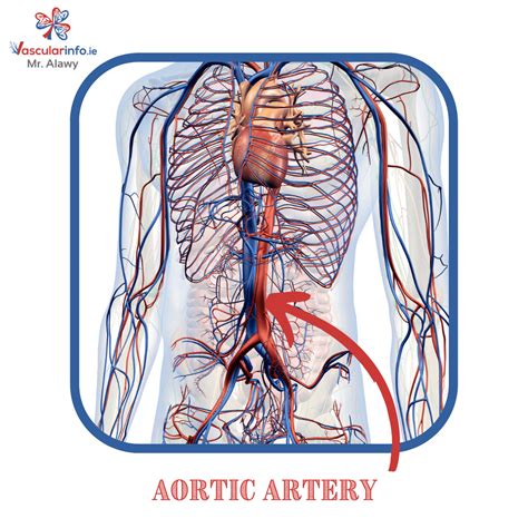 Abdominal Aortic Aneurysm(AAA) - Vascular Info