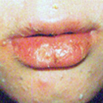 Accutane How Long Do Dry Lips Last Lipstutorial Org