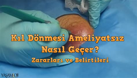 Kıl Dönmesi Neden Olur ve Nasıl Geçer Yasamloji