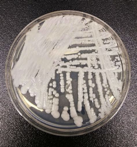 The potentially deadly Candida auris fungus is spreading quickly in the U.S.