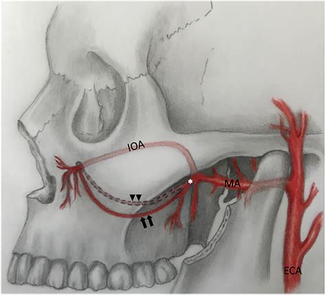 Schematic Drawing Illustrating Anastomosis Between Posterior Superior