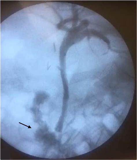 Cholangiography Through Biliary Pigtail Drainage Two Days After