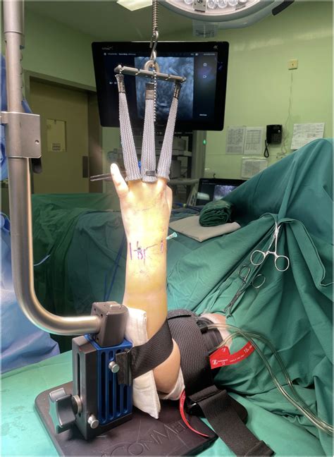 Arthroscopic Assisted Distal Radius Fracture Fixation Aadrf Using The