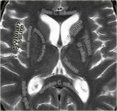 Basal Ganglia MRI