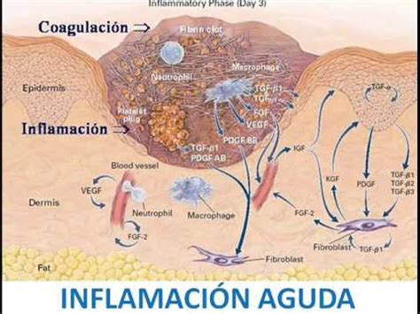 Inflamación Aguda Fisiopatología YouTube