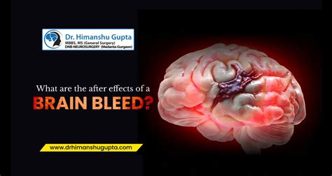 What are the after effects of a brain bleed?