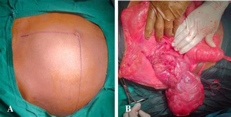 Figure From Rare Case Of Giant Retroperitoneal Sarcoma Semantic Scholar