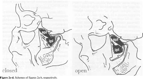 Figure 1 From Real Function Of Superior Head Of Lateral Pterygoid