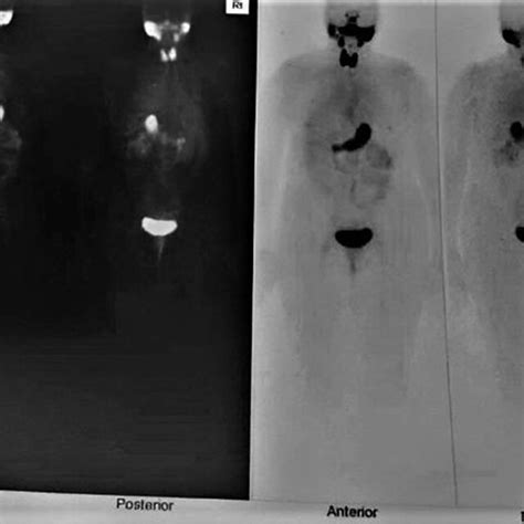 Iodine 123 Whole Body Scan Was Performed Results Reported That No