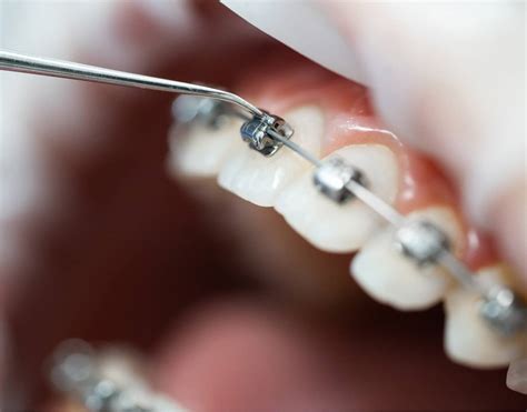 Les bénéfices dun traitement orthodontique sur la santé bucco dentaire