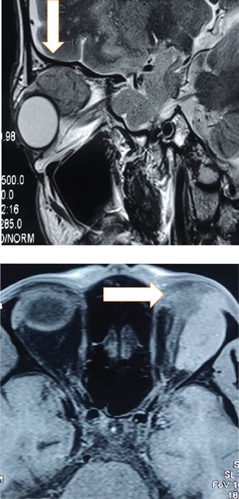 CE MRI Contrast Enhanced Magnetic Resonance Imaging Showing Left