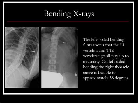 Case Review 22 21 Year Old With Progressive Adolescent Idiopathic