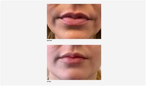 Botox Lip Flip Vs Lip Filler Pain Level Results Realself News