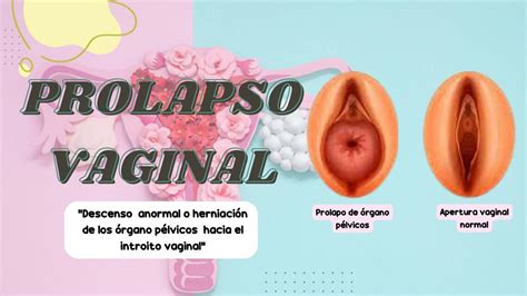 Prolapso Vaginal Koralia Vara Meza Udocz