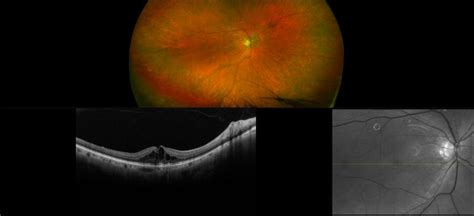 Monaco - Macular Pseudohole, RG