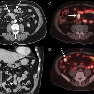 76 Year Old Man With Biopsy Proven Pancreatic Neuroendocrine Tumor At