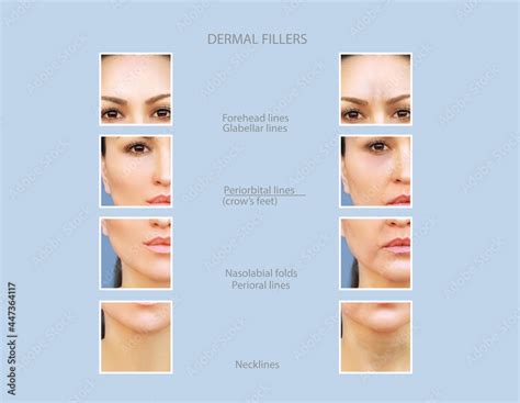 Dermal Filler Treatments Hyaluronic Acid Injections For Specific Areas