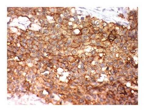 Immunohistochemical Staining Of Nedd9 In Transitional Cell Carcinoma