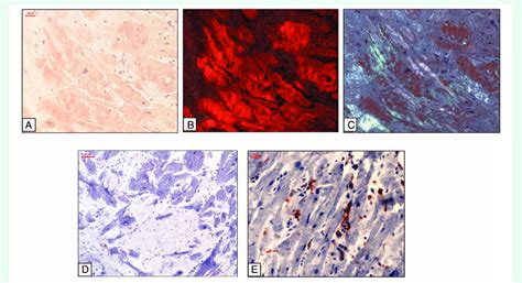 Representative Images Of Al Amyloidosis A Congo Red Stain Under