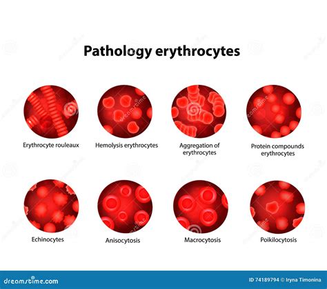 Patologia Dei Globuli Rossi Eritrociti Insieme Infographics