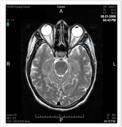 Left optic nerve enlarged and thickened in keeping of optic neuritis ...