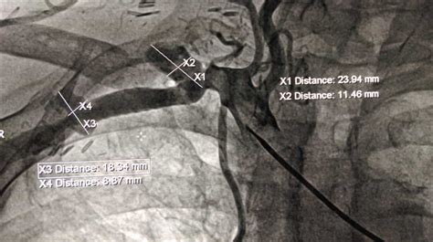 The use of stent-graft-alternative treatment of aneurysms