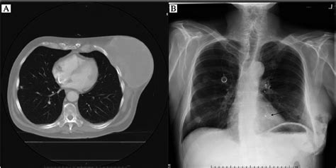 Pretreatment chest CT scan (A) showing left chest wall sarcoma and ...