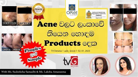 O Pimples With Laksha Amarasena And