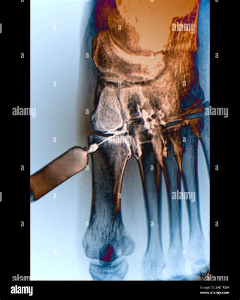 Foot pain being treated, X-ray of a section through the foot of a 30-year-old sportsman ...