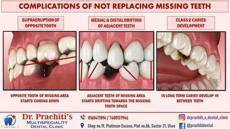 The Unseen Impact Consequences Of Not Replacing A Missing Tooth