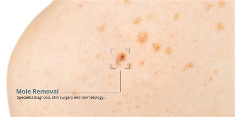 Mole And Skin Check Christchurch Dermatologists Dermatologic Surgeons