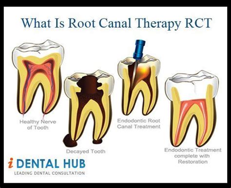 Root Canal Post Care Vbgarden