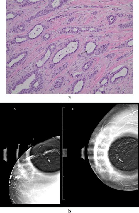 Pathological And Radiological Findings Of A Tubular Carcinoma Case