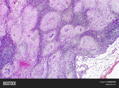 Caseous Necrosis Histology