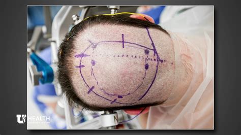 Left Occipital Craniotomy For Resection Of Falcotentorial Meningioma