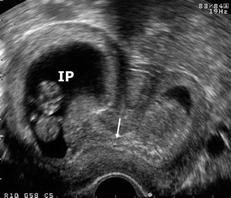 9 Week Ectopic Pregnancy Ultrasound