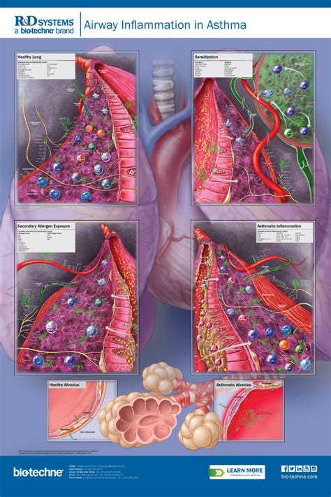 Asthma Airway Inflammation