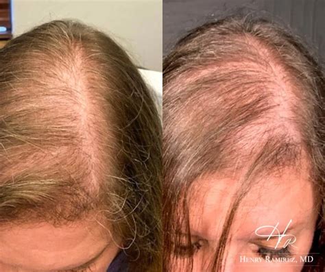 Hair Restoration For Women Ardmore Ok Near Okc And Tulsa